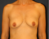 Feel Beautiful - Breast Augmentation Lift 55 - Before Photo
